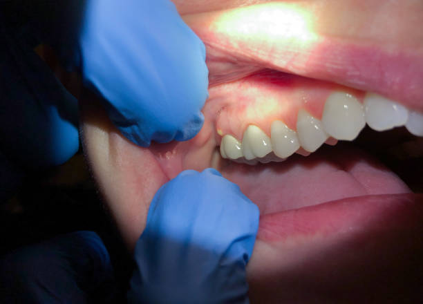 Best Knocked-Out Tooth (Avulsed Tooth) Treatment in Riverside, IL